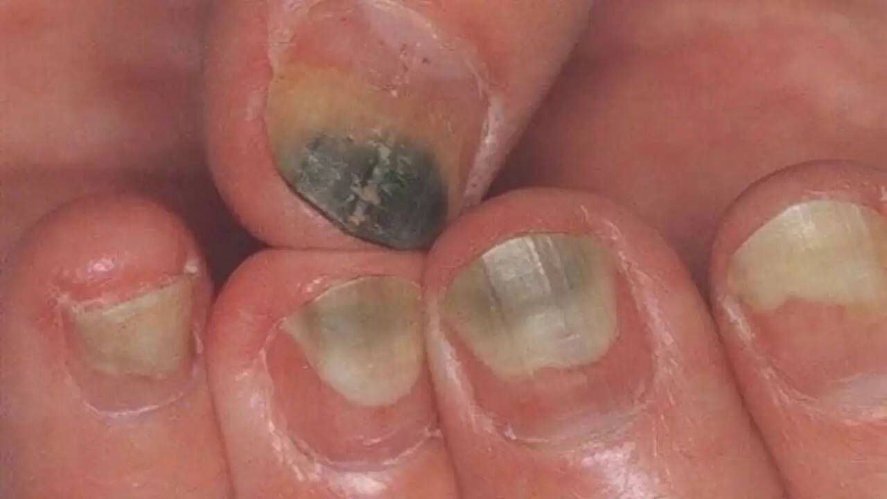नाखूनों पर काली रेखा: स्वास्थ्य के संकेत और सावधानियां
