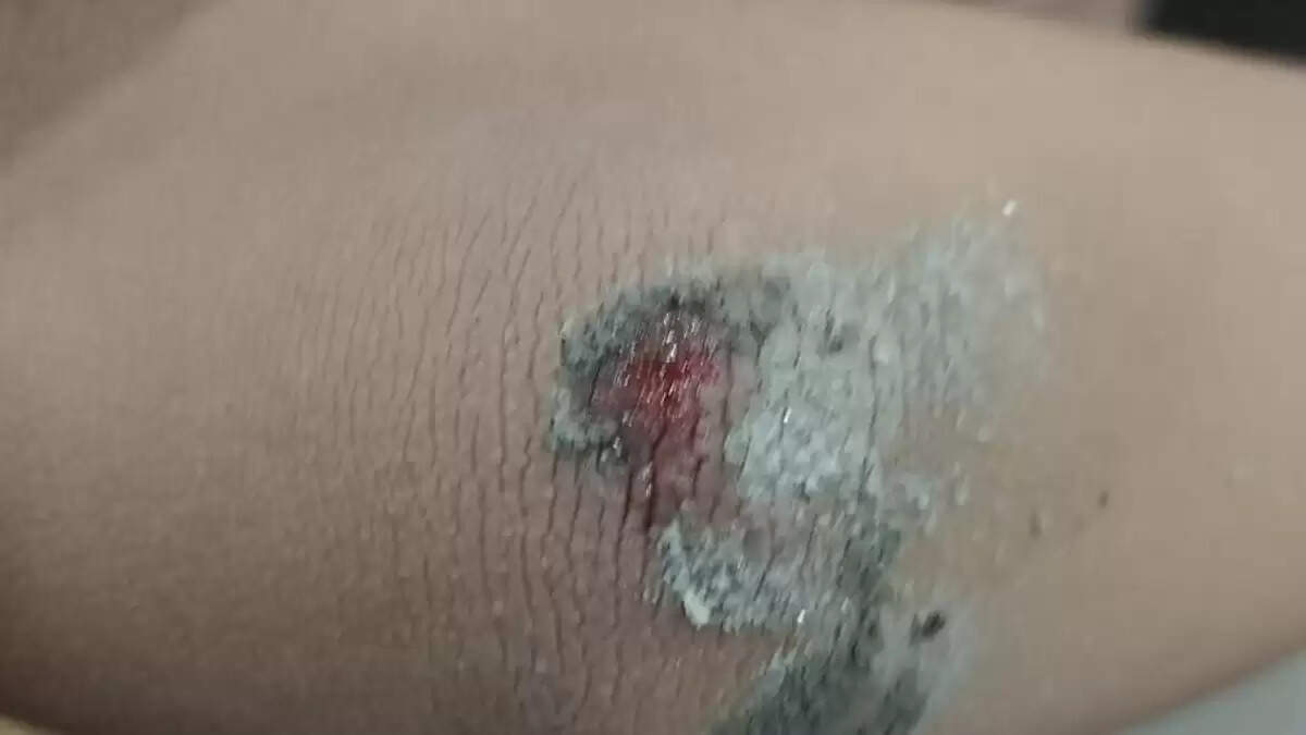 ग्रेटर नोएडा वेस्ट में कुत्ते के हमले से बच्चे की जान पर बनी आफत
