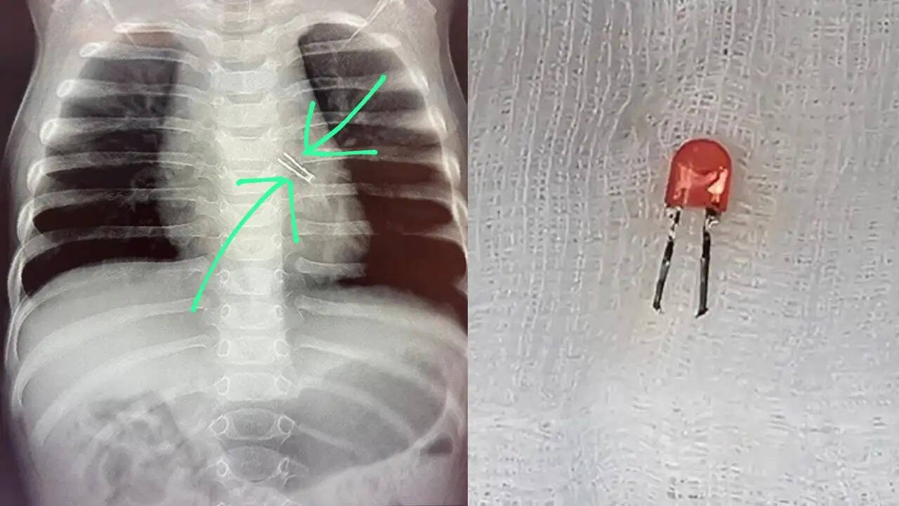 पुणे में डॉक्टरों ने 9 महीने के बच्चे की जान बचाई, एलईडी बल्ब निकाला