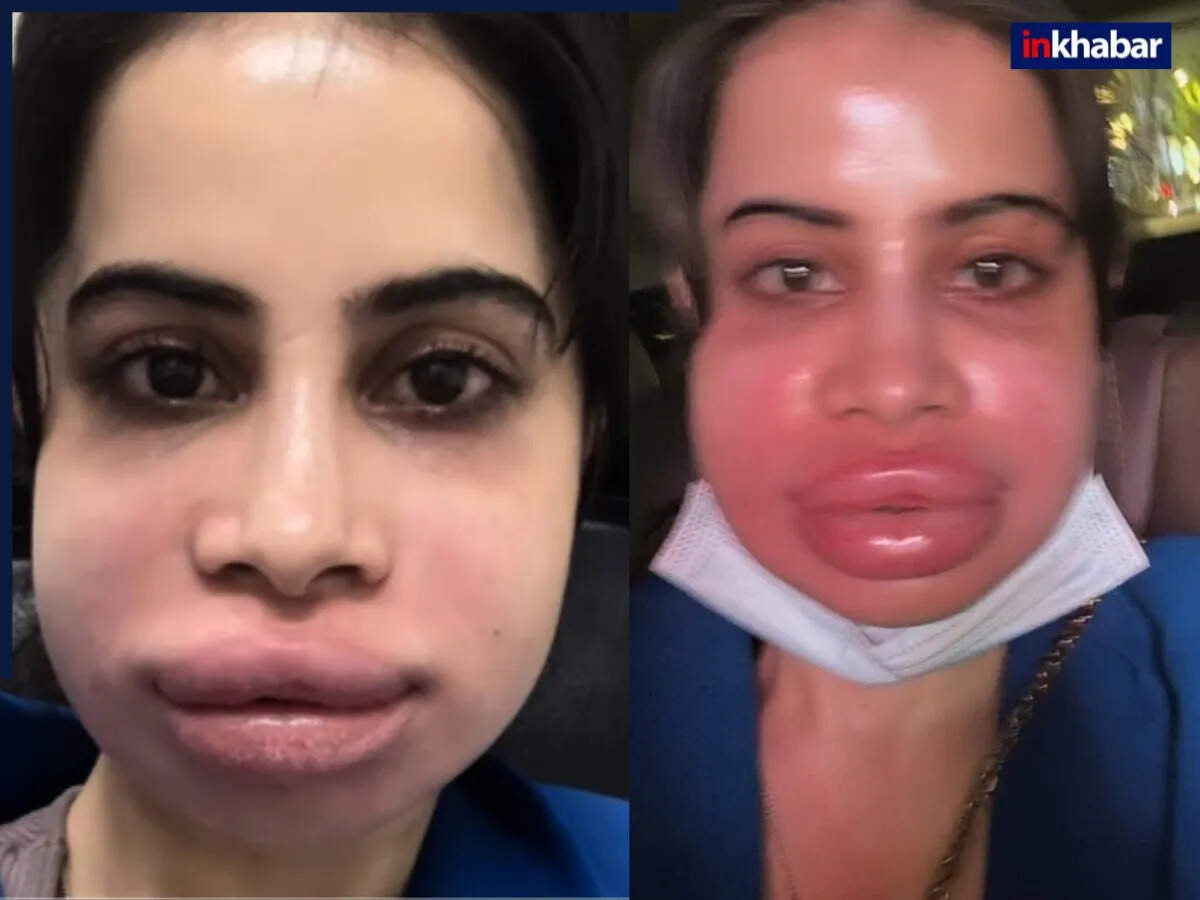 ऊर्फी जावेद के सूजे चेहरे ने बढ़ाई फैंस की चिंता