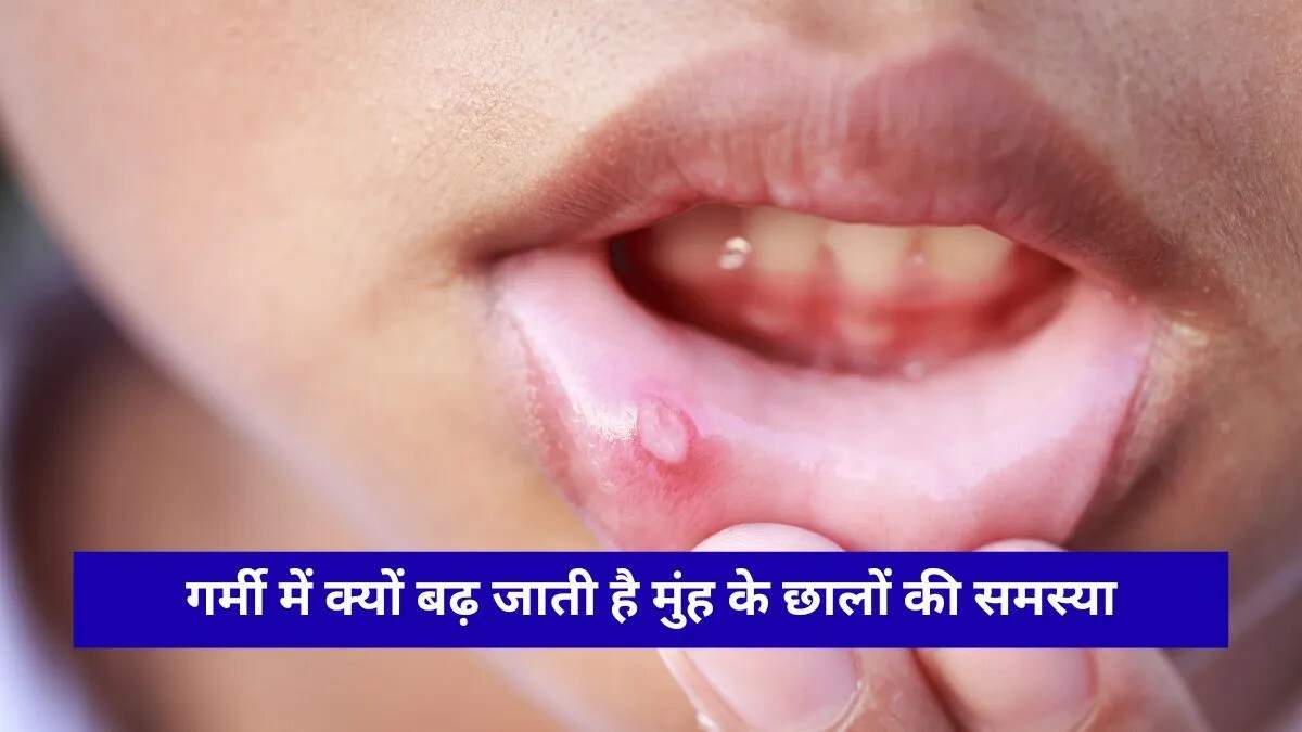 गर्मी में मुंह के छालों से राहत पाने के घरेलू उपाय