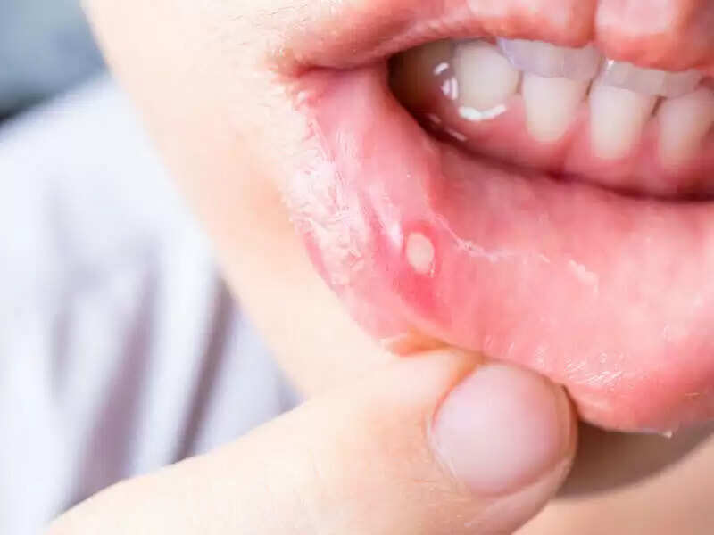 तुलसी के पत्तों से मुंह के अल्सर का प्रभावी इलाज