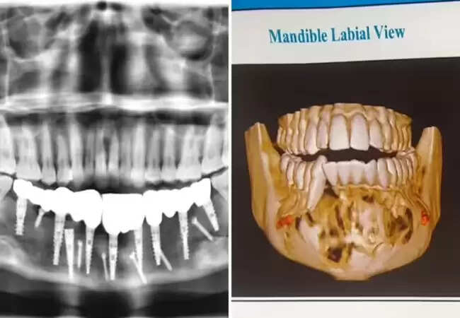 24 वर्षीय युवती के मुंह में ट्यूमर, डॉक्टरों ने किया सफल इलाज