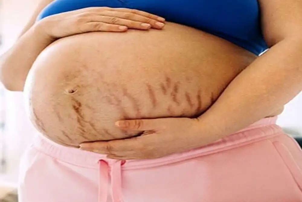 गर्भावस्था में स्ट्रेच मार्क्स से निपटने के आयुर्वेदिक उपाय