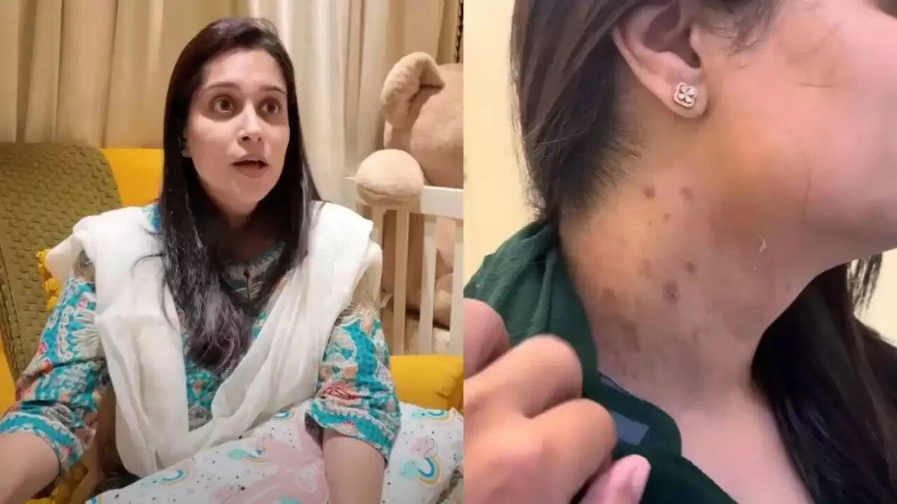 दीपिका कक्कड़ की स्वास्थ्य यात्रा: लिवर कैंसर सर्जरी के बाद की चुनौतियाँ