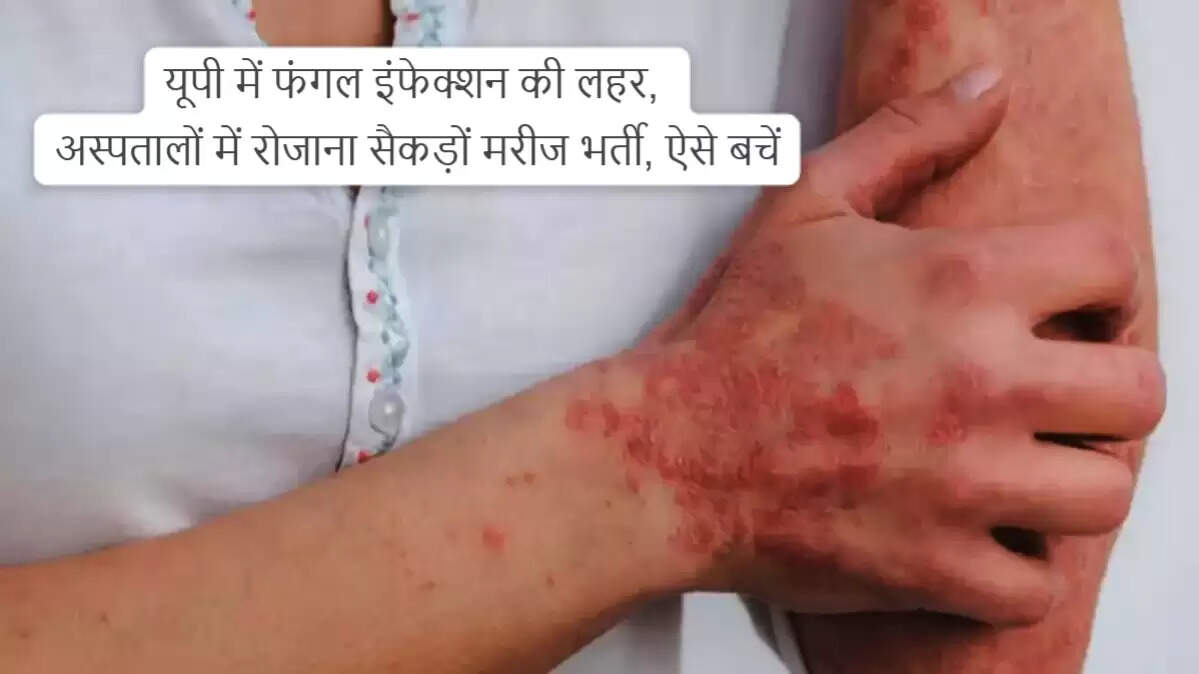 उत्तर प्रदेश में फंगल संक्रमण की बढ़ती समस्या: जानें बचाव के उपाय