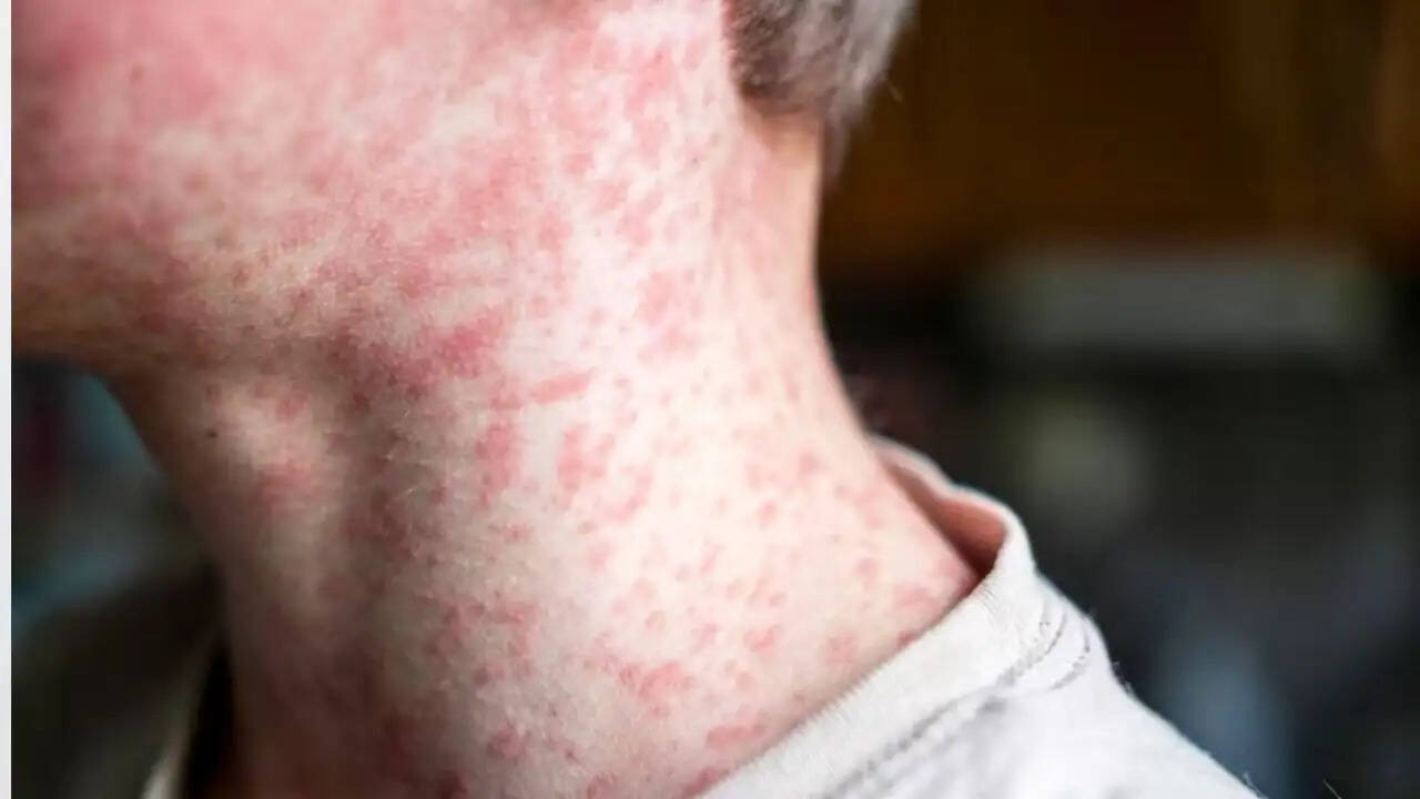 बांग्लादेश में खसरे का प्रकोप: बच्चों के लिए टीकाकरण अभियान शुरू