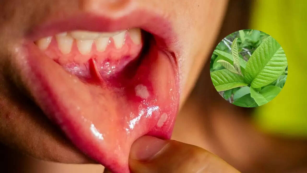 मुंह के छालों का आयुर्वेदिक उपचार: अमरुद के पत्तों के फायदे
