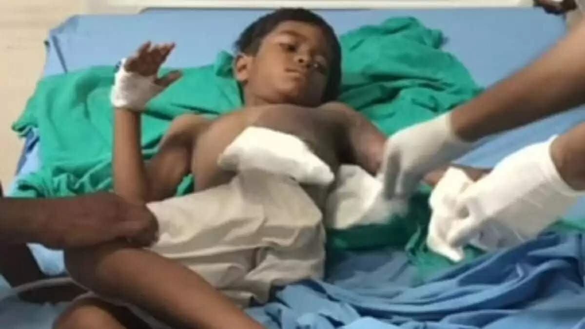 ग्रेटर नोएडा में ट्रांसफार्मर से झुलसने वाला बच्चा अस्पताल में भर्ती