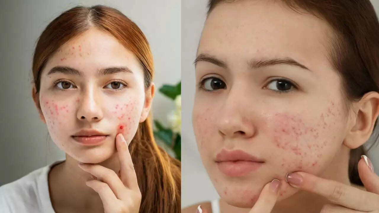 पिंपल्स के लिए प्रभावी घरेलू उपाय