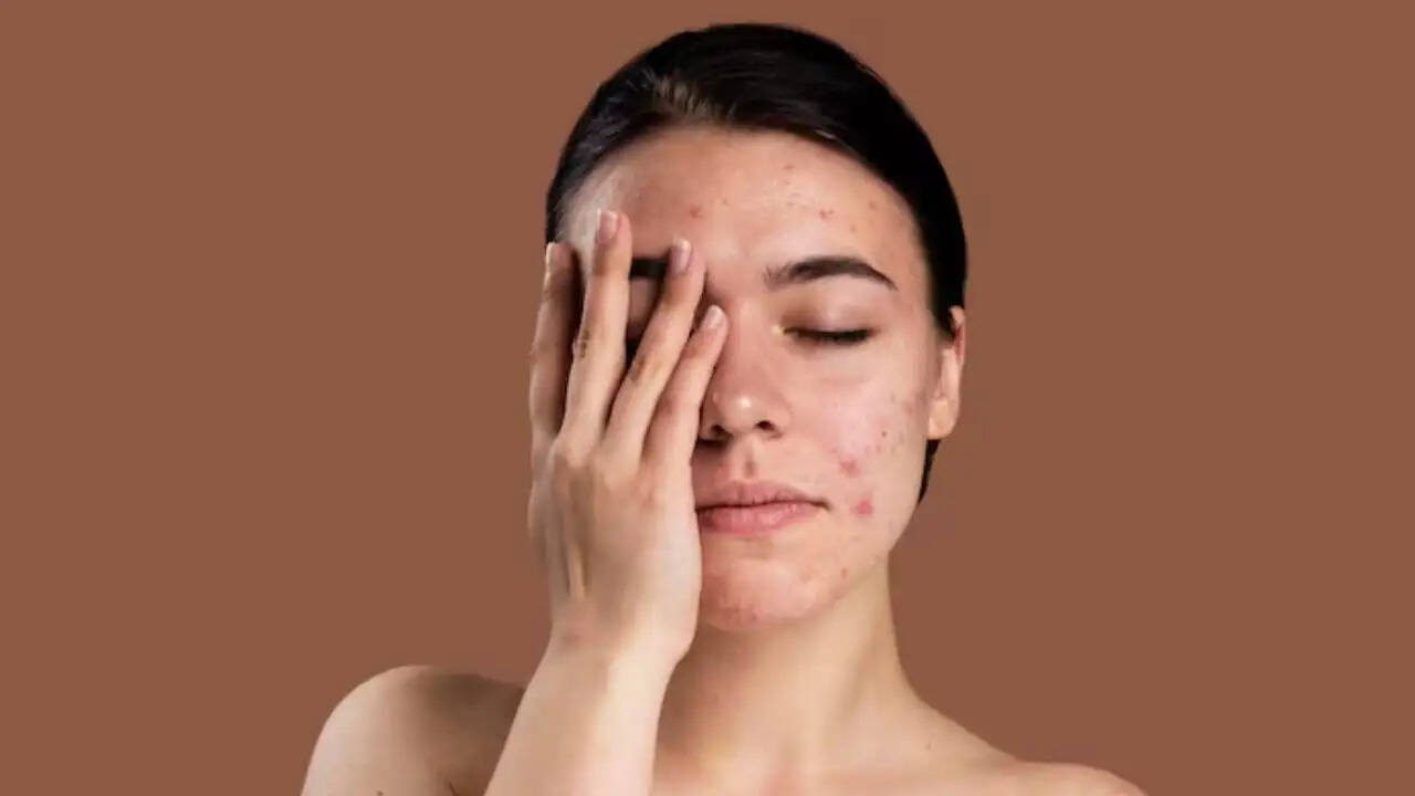 गर्मी में मुंहासों से बचने के लिए क्या न खाएं?