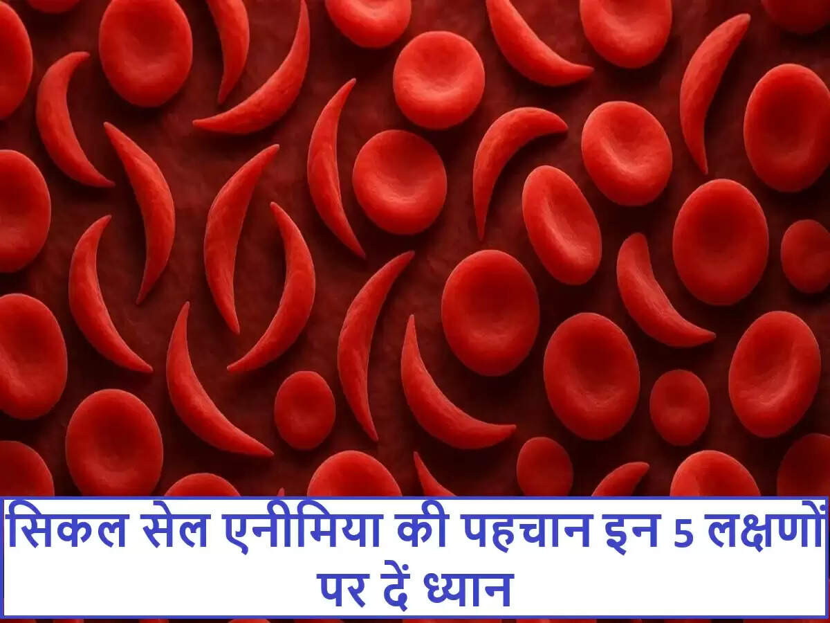 सिकल सेल एनीमिया: जानें इसके लक्षण और पहचानने के तरीके