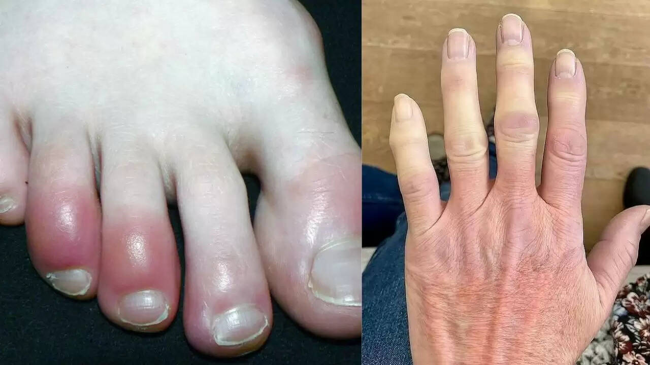 सर्दियों में सूजी उंगलियों से राहत पाने के घरेलू उपाय