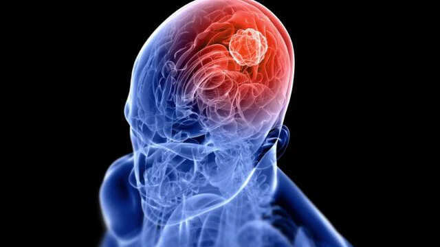 ब्रेन ट्यूमर से बचने के लिए किन खाद्य पदार्थों से करें परहेज?