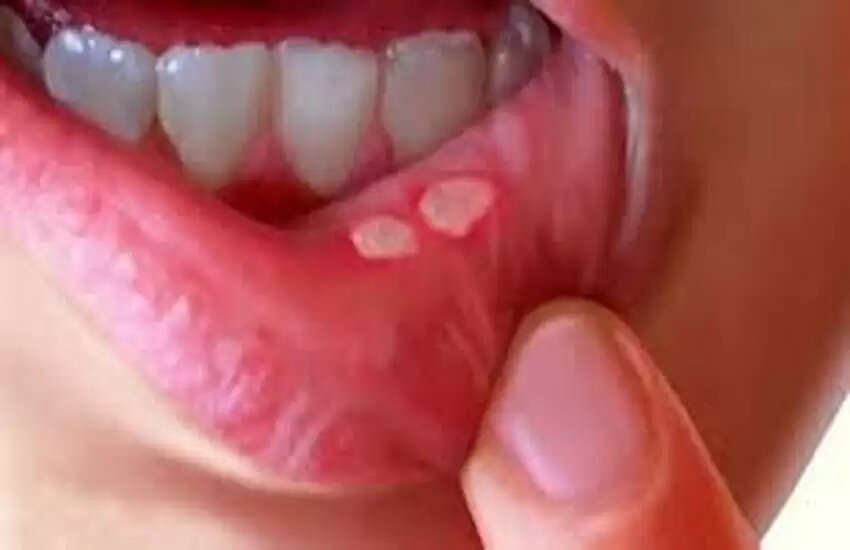 मुंह के छालों से राहत पाने के लिए अमरूद का सेवन करें