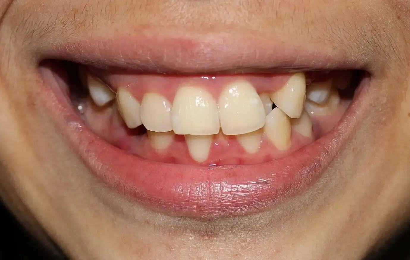 दांतों के लिए क्लीयर अलाइनर: एक नई तकनीक जो आपके मुस्कान को संवारती है