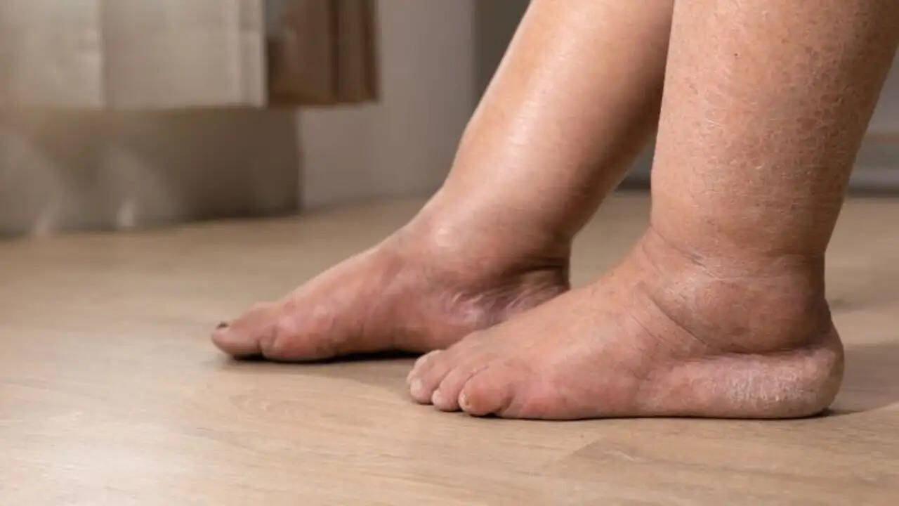 पैरों में सूजन: दिल की सेहत का संकेत