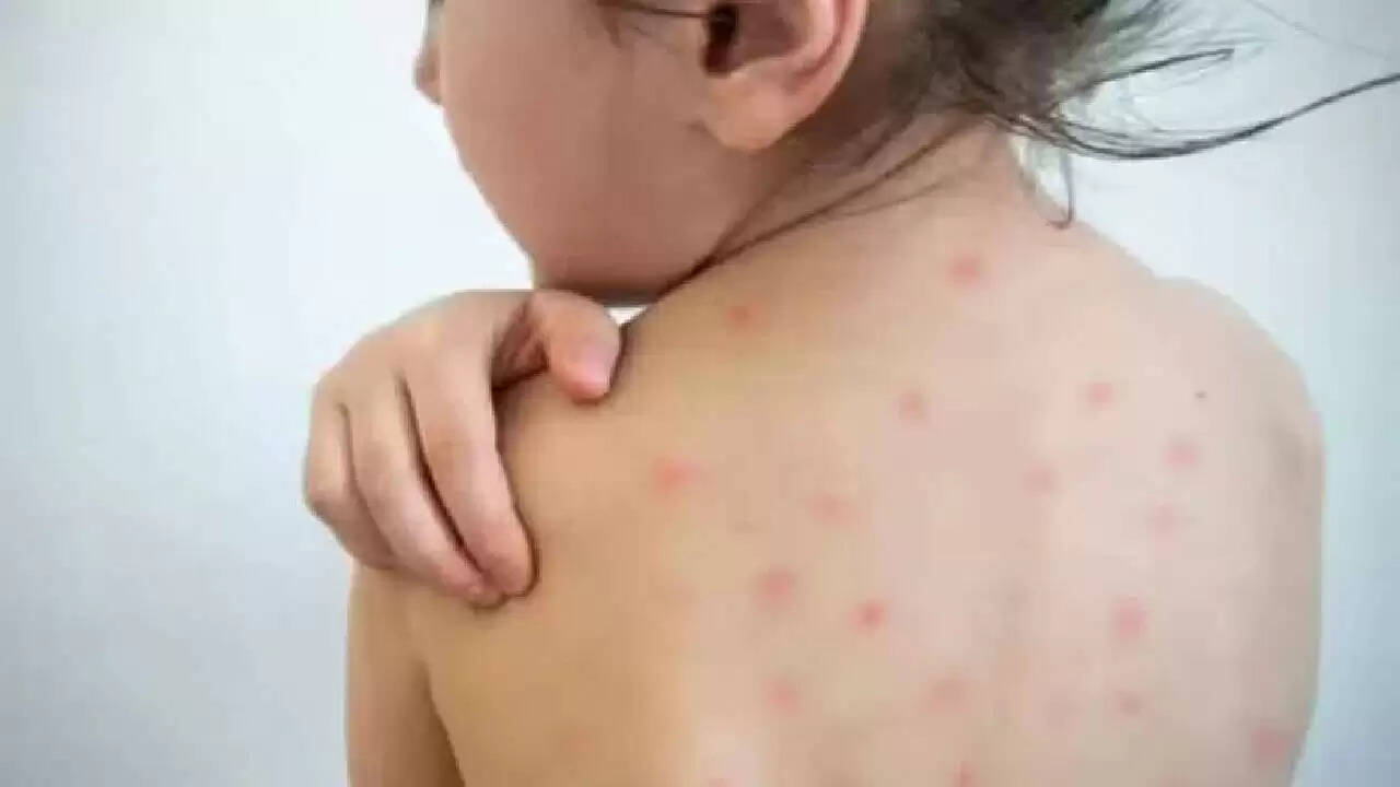खसरा: क्या दुनिया फिर से एक महामारी का सामना कर रही है?