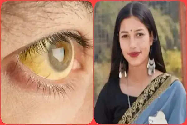 गोहर में पीलिया का प्रकोप: 19 वर्षीय नवविवाहिता की मौत, मरीजों की संख्या 210 पार