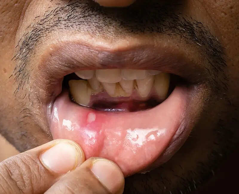 मुंह के छालों से राहत पाने के लिए अमरूद का सेवन करें