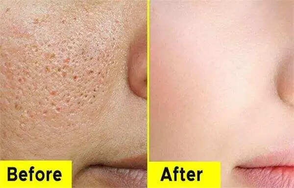 खुले रोमछिद्रों की समस्या: कारण और समाधान