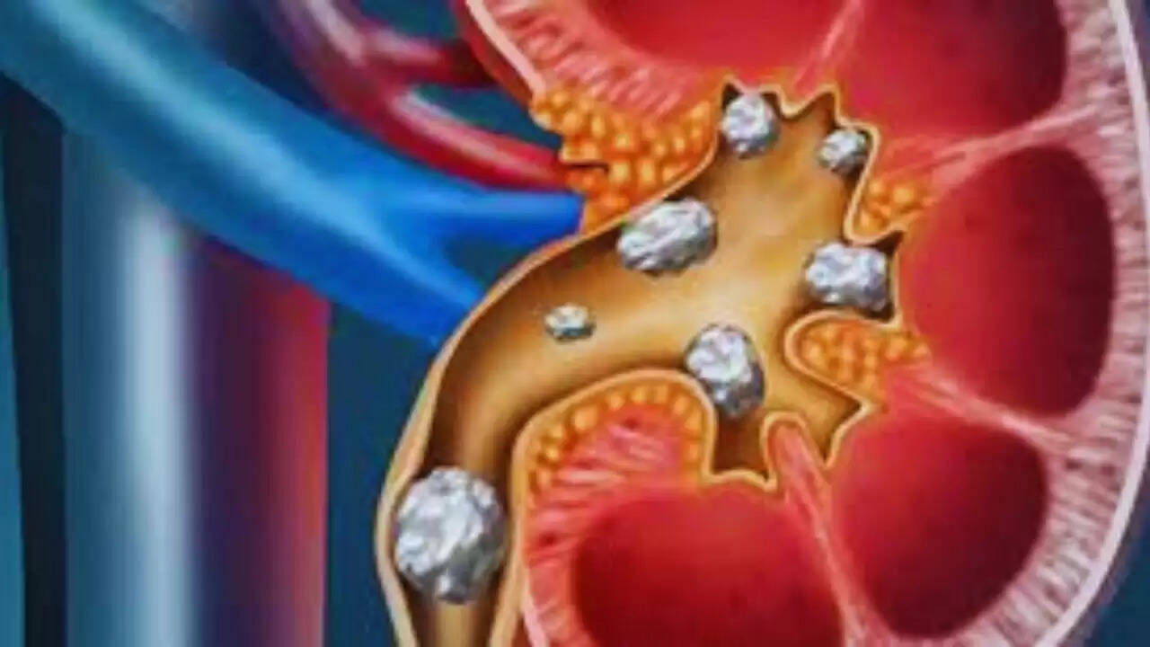 क्या आप किडनी स्टोन से बचना चाहते हैं? जानें पानी की कमी के संकेत और बचाव के उपाय