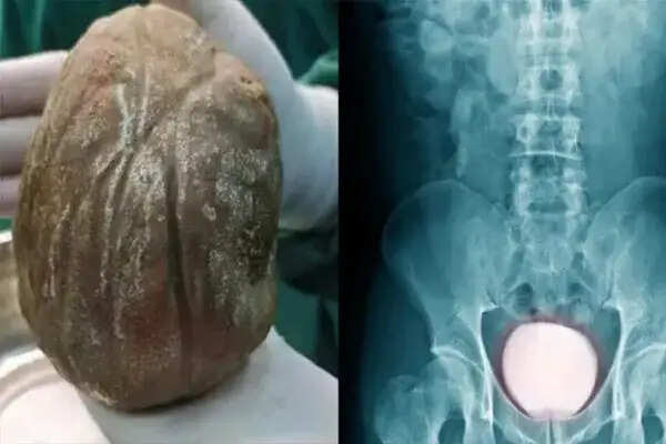 चीन में किसान के मूत्राशय से निकली 1.3 किलोग्राम की पथरी, डॉक्टर भी हैरान