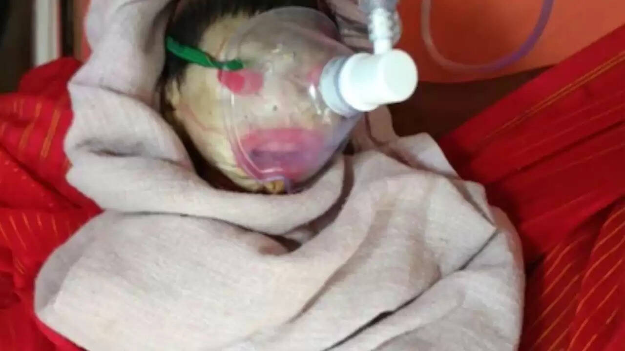 मध्य प्रदेश में जन्मा अनोखा नवजात: एलियन जैसी त्वचा से सबको किया हैरान