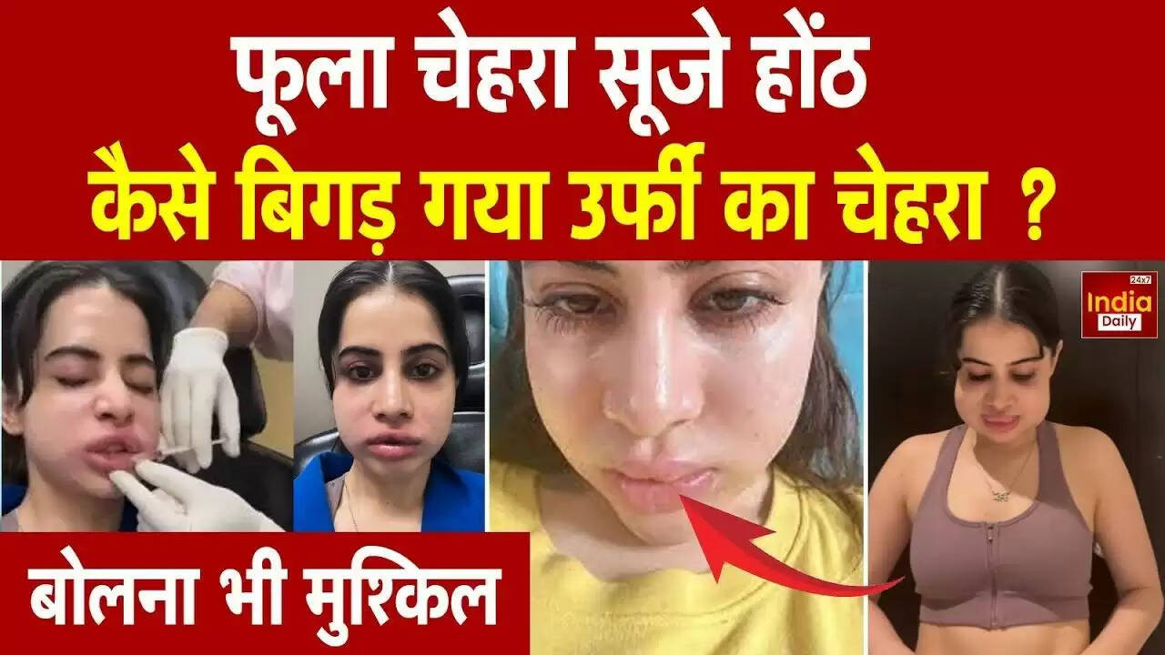 उर्फी जावेद का नया लुक: लिप फिलर्स हटाने के बाद फैंस की चिंता बढ़ी