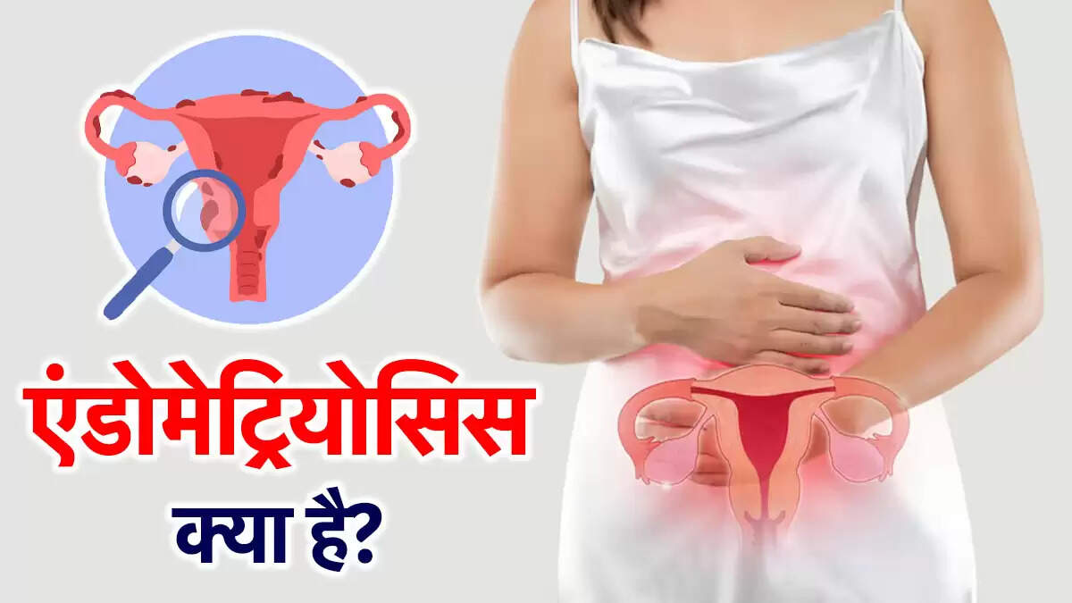 एंडोमेट्रियोसिस: महिलाओं में लक्षण और उपचार के तरीके