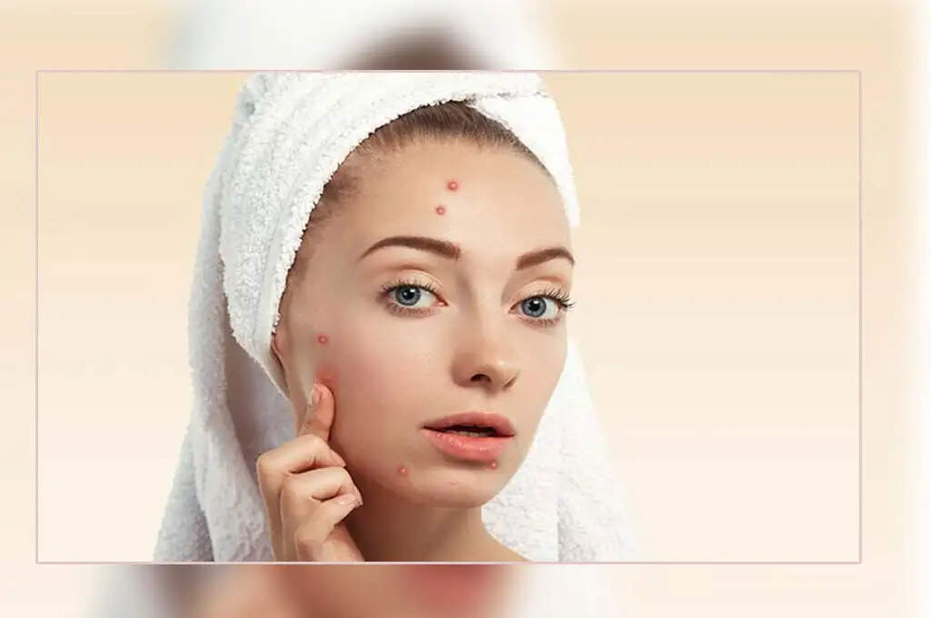 चंदन और गुलाब जल से पाएं कील-मुहासों से छुटकारा