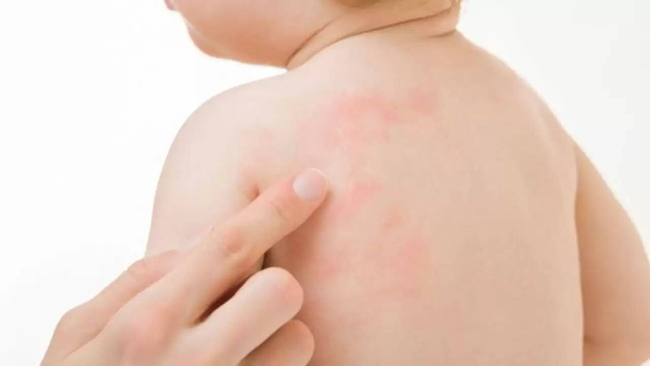 मानसून में त्वचा की समस्याओं से राहत पाने के लिए घरेलू उपाय