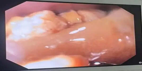 वाराणसी : खाने की नली में फंसें नकली दांत को बीएचयू चिकित्सकों ने निकाल बचाई मरीज की जान