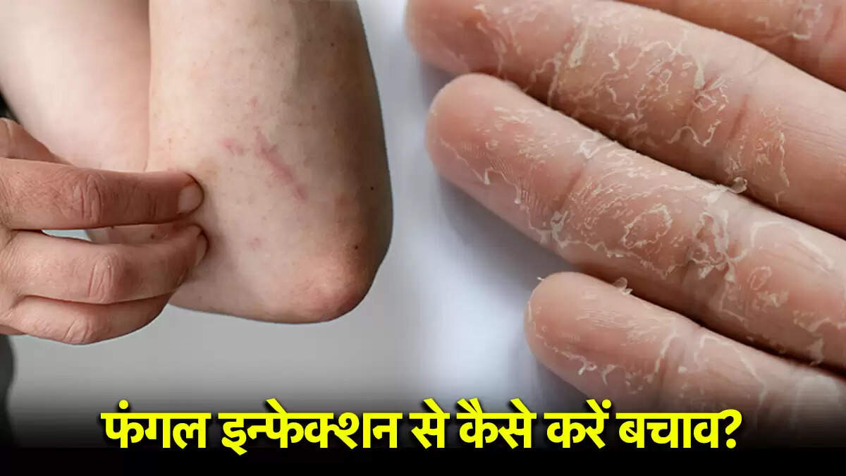 गर्मियों में फंगल इन्फेक्शन से बचने के उपाय