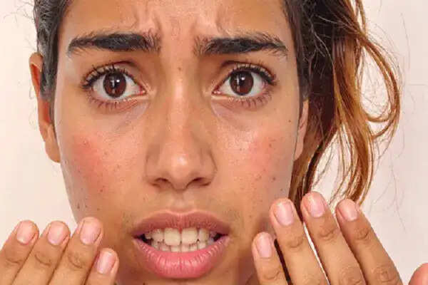 गर्मी में सनबर्न से राहत के लिए घरेलू उपाय