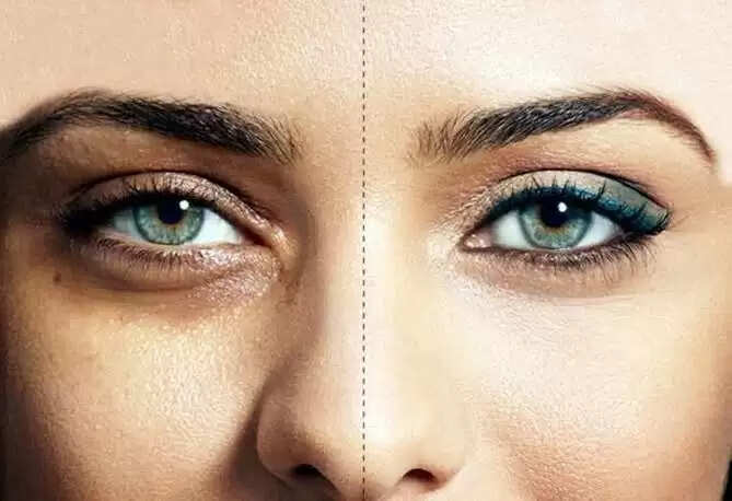 आंखों के नीचे की झुर्रियों से छुटकारा पाने का प्राकृतिक उपाय: जानें शहतूत के फायदे