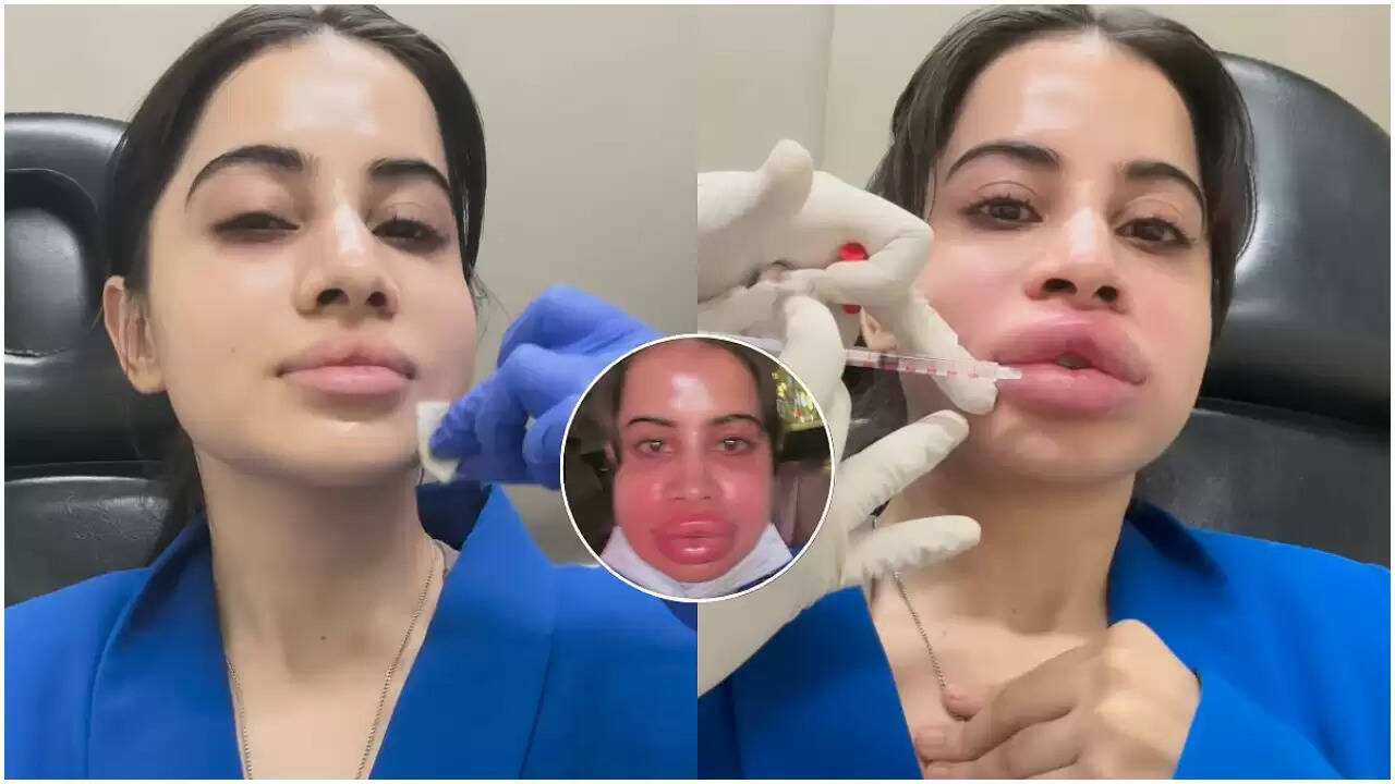 ऊर्फी जावेद ने लिप फिलर्स हटाने का लिया फैसला, साझा किया वीडियो