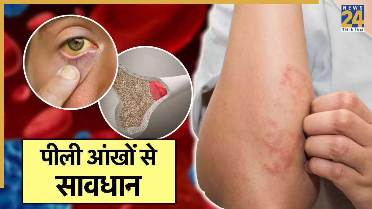 ल्यूकेमिया के लक्षण: आंखों का पीला रंग और अन्य चेतावनियाँ