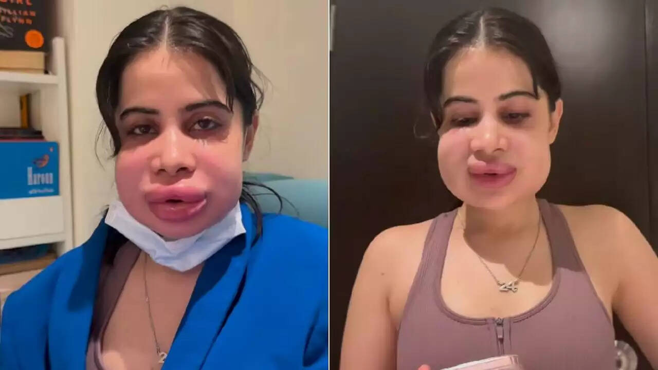 उर्फी जावेद ने लिप फिलर्स हटाने के बाद दिखाई अपनी सच्चाई