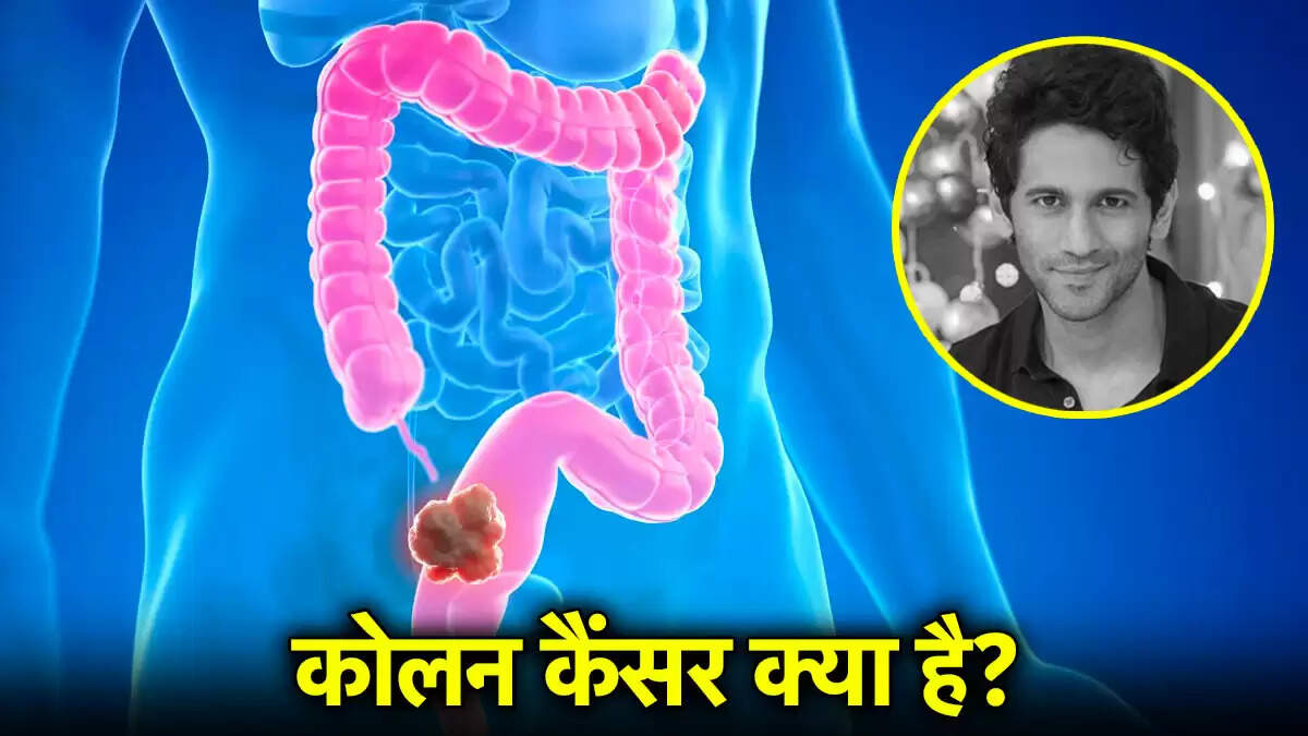 कोलन कैंसर: युवाओं में बढ़ती समस्या और इसके लक्षण