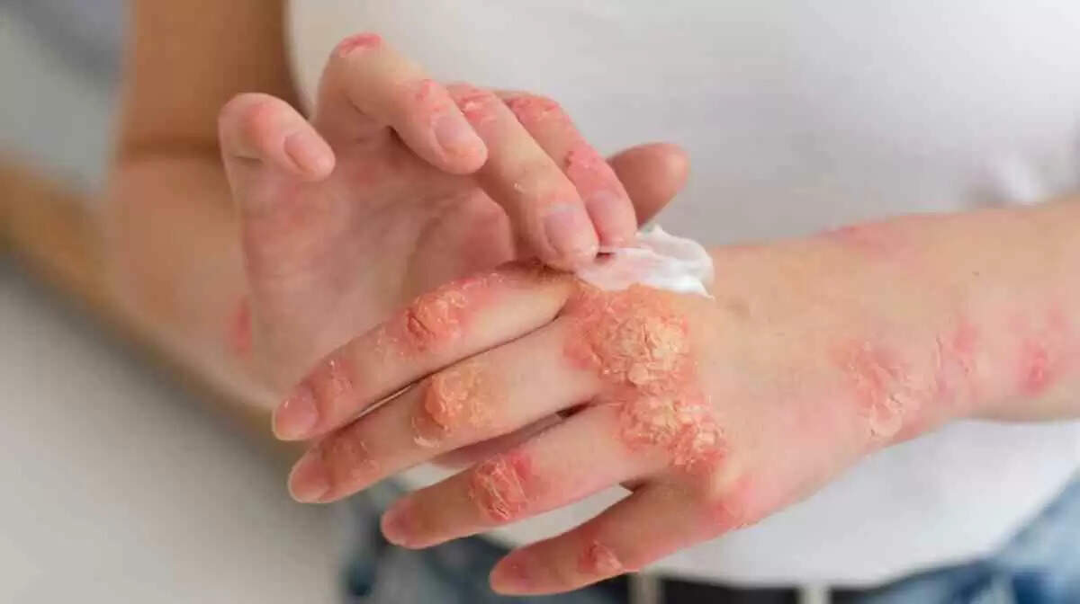 मानसून में फंगल संक्रमण से बचने के लिए 5 प्रभावी घरेलू उपाय