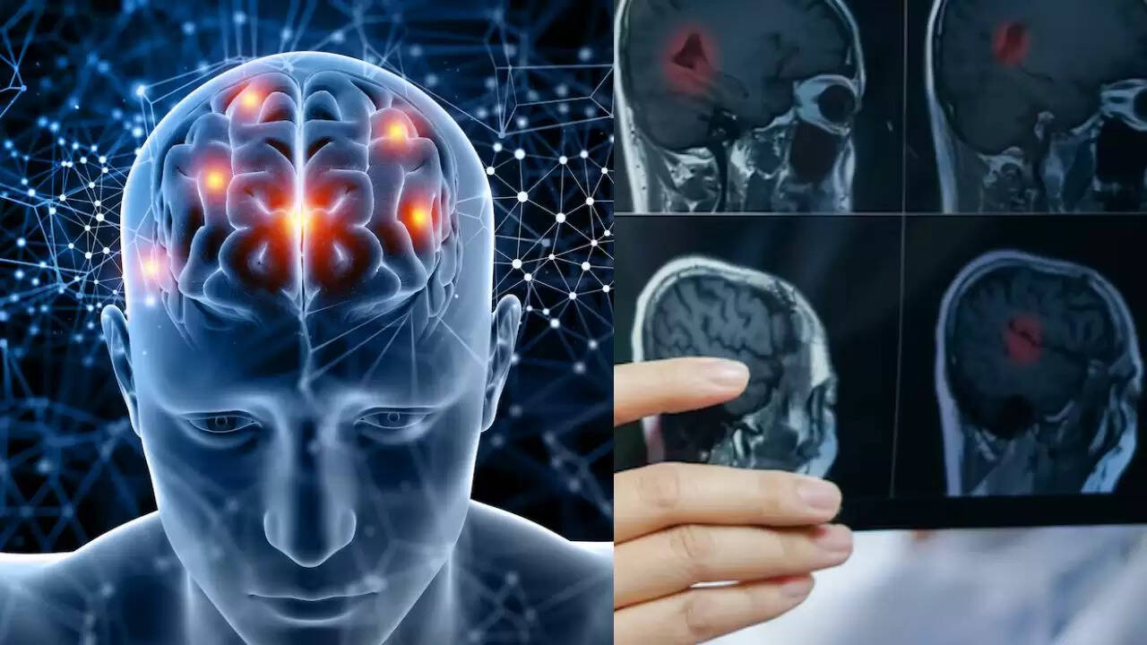 सिरदर्द और ट्यूमर: जानें लक्षण और विशेषज्ञ की राय