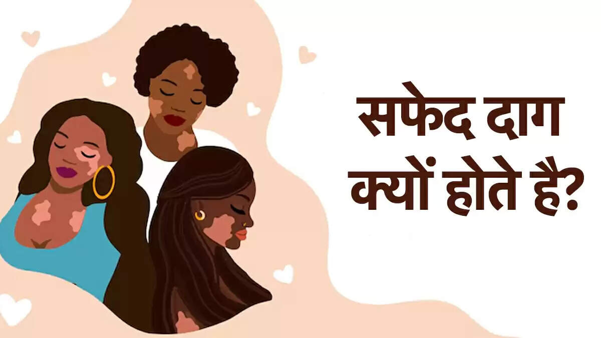 विश्व विटिलिगो दिवस 2025: जानें इस बीमारी के बारे में महत्वपूर्ण तथ्य