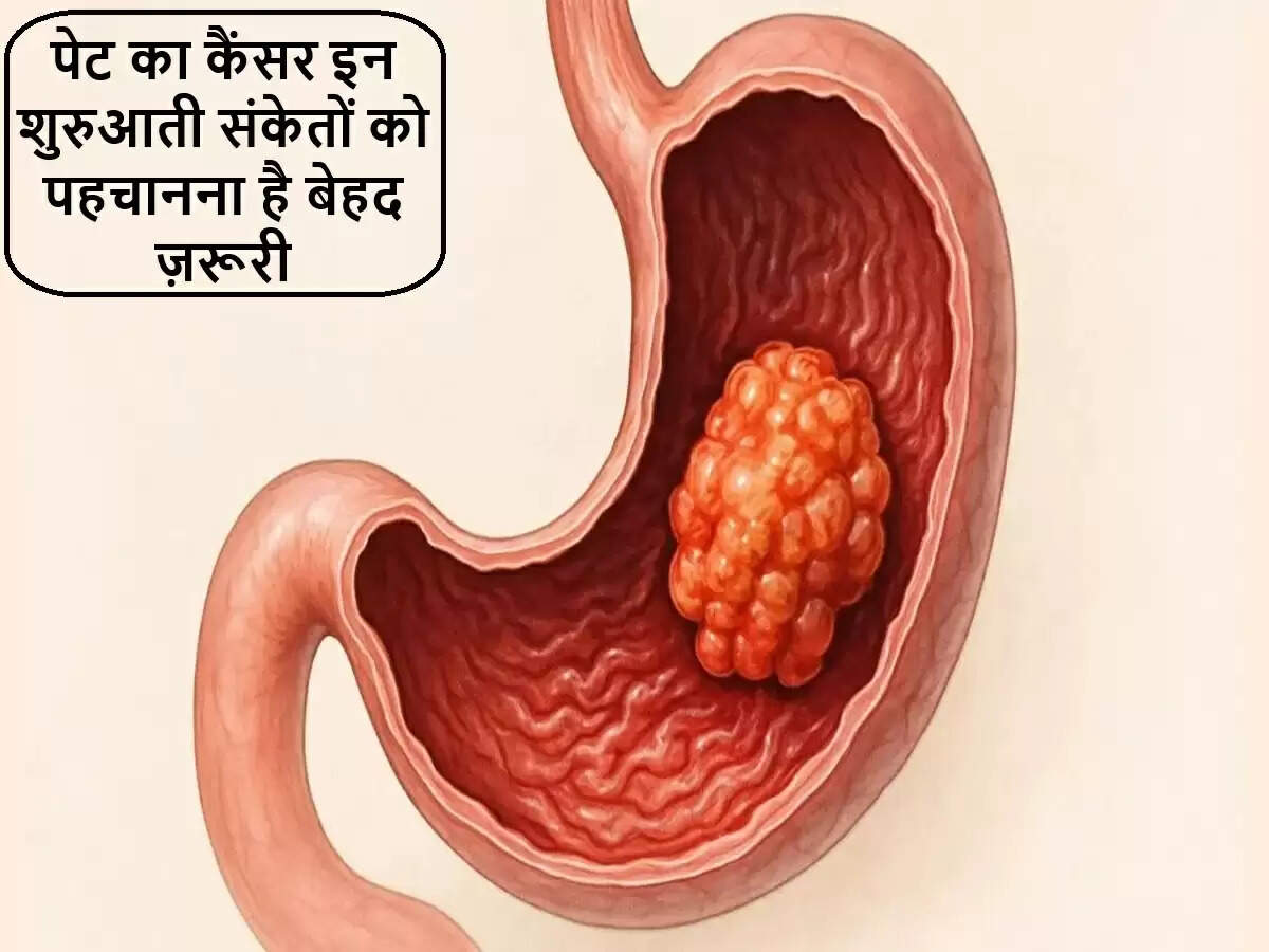पेट के कैंसर के शुरुआती लक्षण: जानें कब करें डॉक्टर से संपर्क