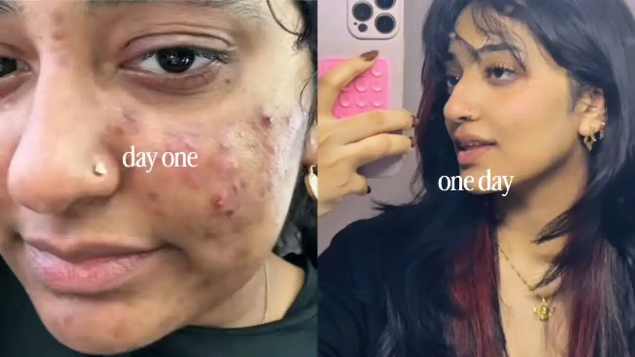 दुबई की युवती का स्किन ट्रांसफॉर्मेशन बना वायरल