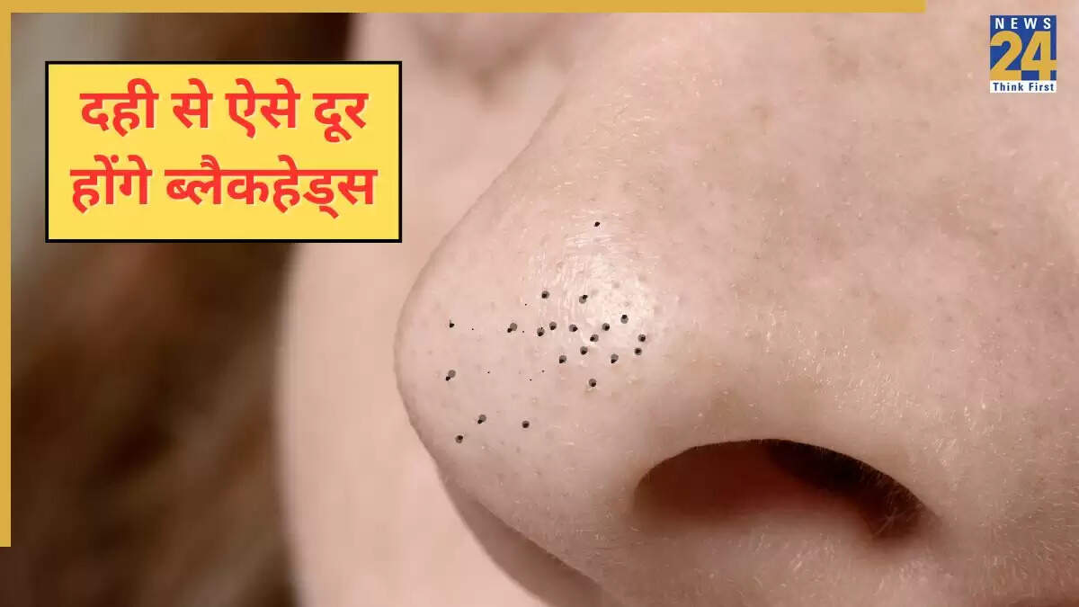 ब्लैकहेड्स से छुटकारा पाने का आसान घरेलू उपाय