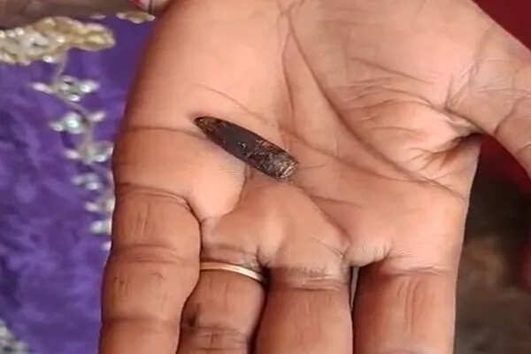 32 वर्षीय महिला के शरीर से निकली SLR राइफल की गोली, जानें पूरा मामला