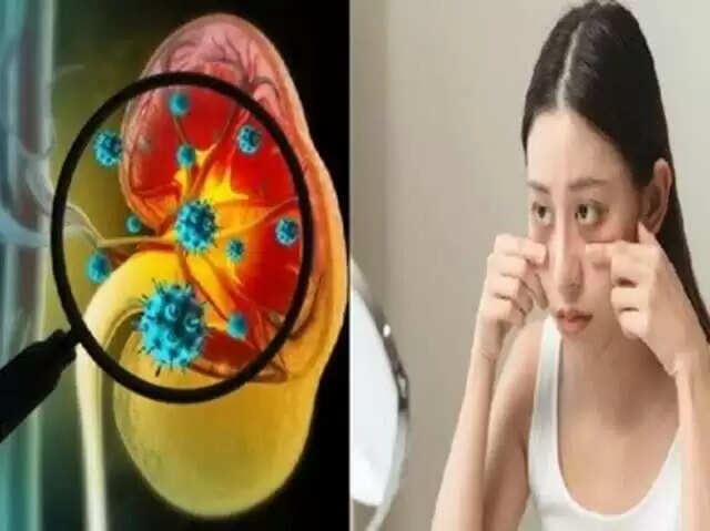 गुर्दे की समस्याओं के संकेत: आँखों में दिखने वाले लक्षण