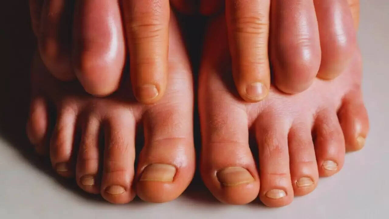 सर्दियों में उंगलियों की सूजन से राहत पाने के घरेलू उपाय