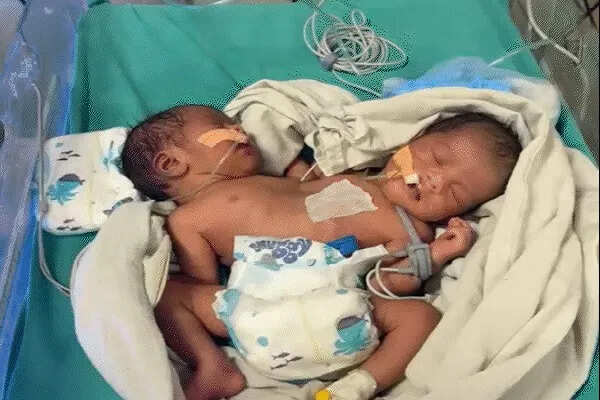 इंदौर में जन्मी अनोखी बच्ची: दो दिल, दो सिर और चार हाथ